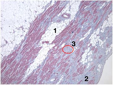 Facts and Gaps in Exercise Influence on Arrhythmogenic Cardiomyopathy: New Insights From a Meta-Analysis Approach